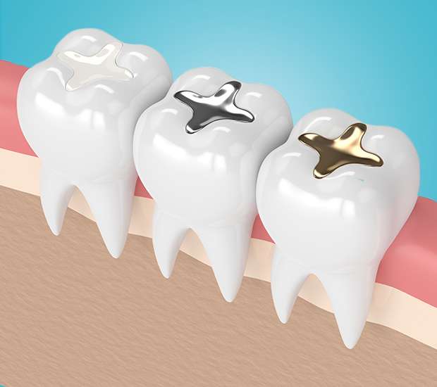 Edina Composite Fillings