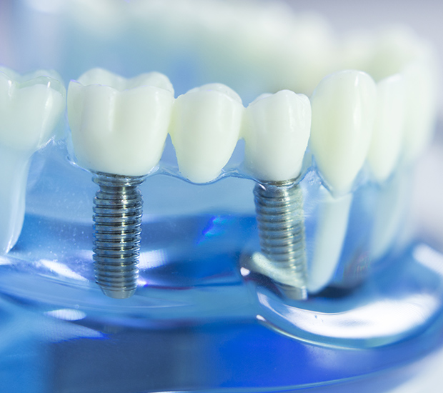 Edina The Dental Implant Procedure