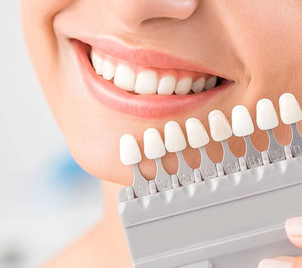 Edina Dental Veneers and Dental Laminates