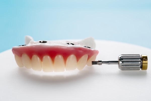 How Stable Are Implant Supported Dentures?