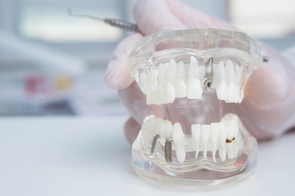 What Happens If I Need My Implant Supported Dentures Repaired?