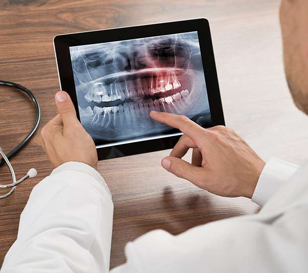 Edina Types of Dental Root Fractures